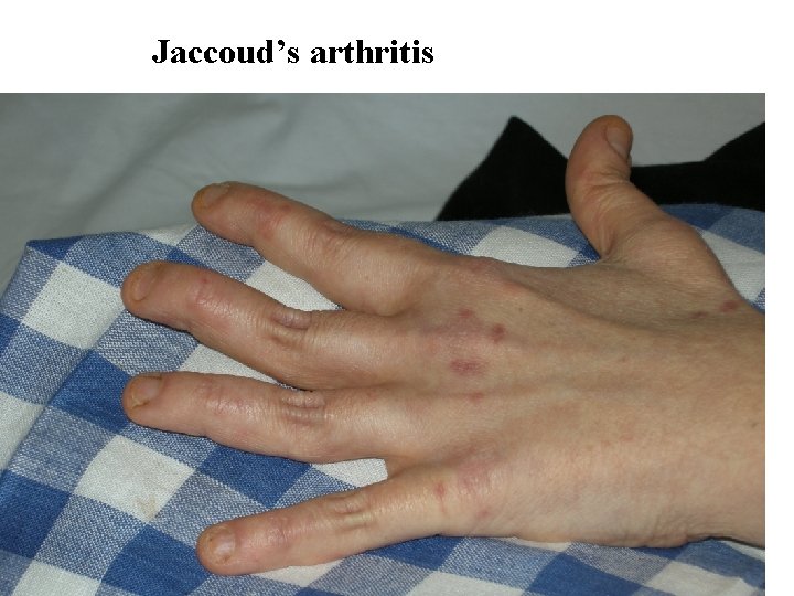 Jaccoud’s arthritis 