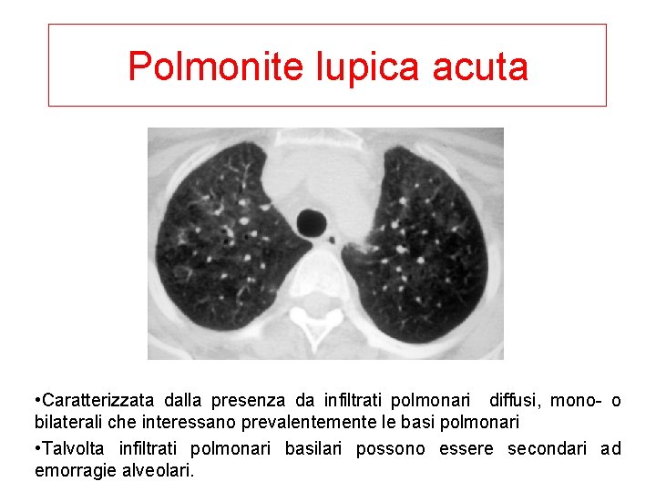 Polmonite lupica acuta • Caratterizzata dalla presenza da infiltrati polmonari diffusi, mono- o bilaterali