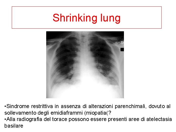 Shrinking lung • Sindrome restrittiva in assenza di alterazioni parenchimali, dovuto al sollevamento degli