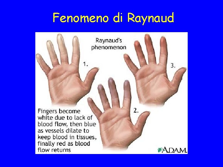 Fenomeno di Raynaud 