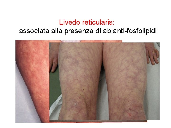 Livedo reticularis: associata alla presenza di ab anti-fosfolipidi 