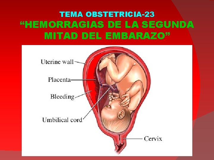 TEMA OBSTETRICIA-23 “HEMORRAGIAS DE LA SEGUNDA MITAD DEL EMBARAZO” 