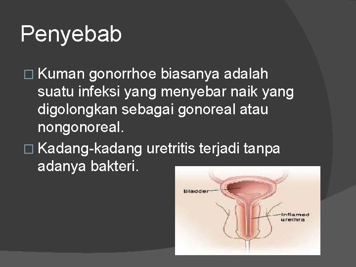 Penyebab � Kuman gonorrhoe biasanya adalah suatu infeksi yang menyebar naik yang digolongkan sebagai Penyebab � Kuman gonorrhoe biasanya adalah suatu infeksi yang menyebar naik yang digolongkan sebagai