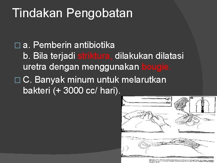 Tindakan Pengobatan � a. Pemberin antibiotika b. Bila terjadi striktura, dilakukan dilatasi uretra dengan Tindakan Pengobatan � a. Pemberin antibiotika b. Bila terjadi striktura, dilakukan dilatasi uretra dengan