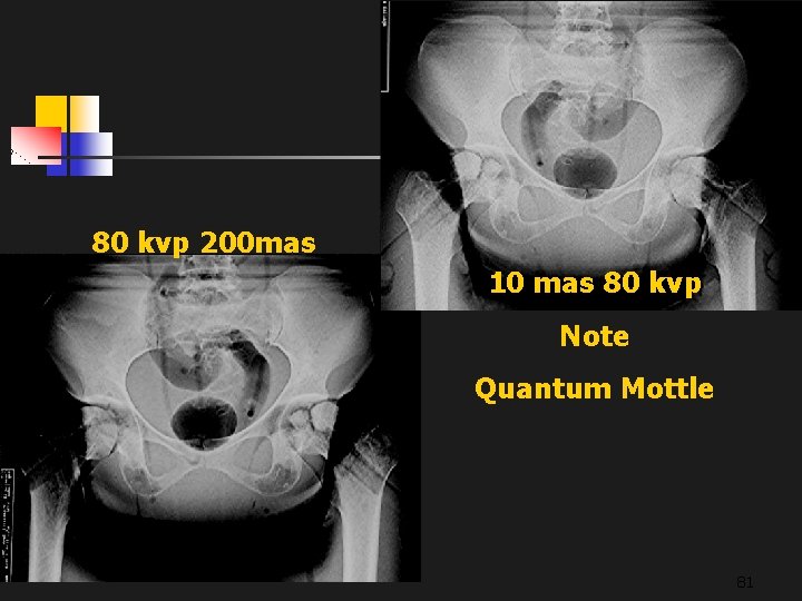 80 kvp 200 mas 10 mas 80 kvp Note Quantum Mottle 81 