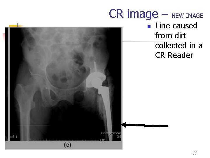 CR image – n NEW IMAGE Line caused from dirt collected in a CR