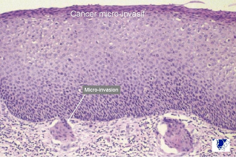 Cancer micro-invasif Micro-invasion 