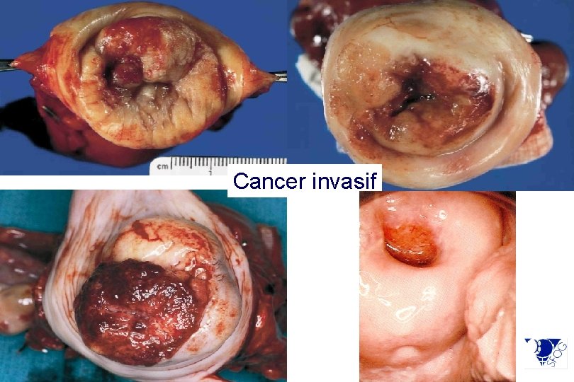 Cancer invasif retour 