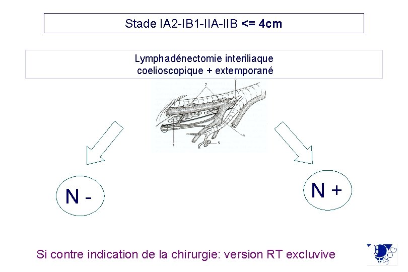 Stade IA 2 -IB 1 -IIA-IIB <= 4 cm Lymphadénectomie interiliaque coelioscopique + extemporané