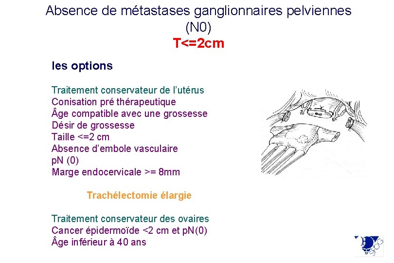 Absence de métastases ganglionnaires pelviennes (N 0) T<=2 cm les options Traitement conservateur de