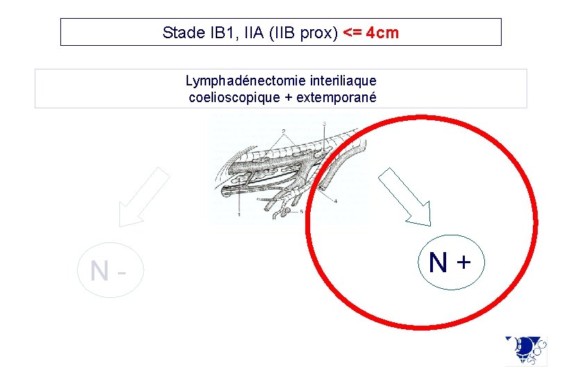 Stade IB 1, IIA (IIB prox) <= 4 cm Lymphadénectomie interiliaque coelioscopique + extemporané