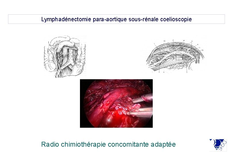 Lymphadénectomie para-aortique sous-rénale coelioscopie Radio chimiothérapie concomitante adaptée 