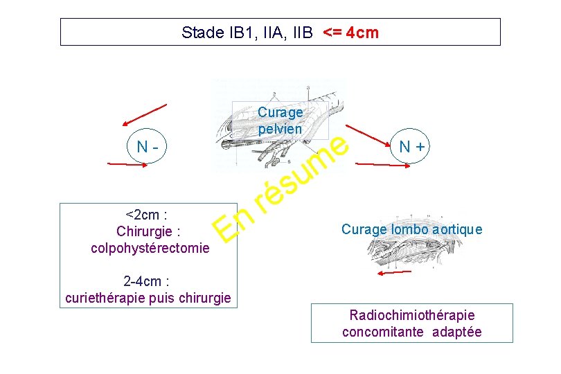 Stade IB 1, IIA, IIB <= 4 cm Curage pelvien N- <2 cm :