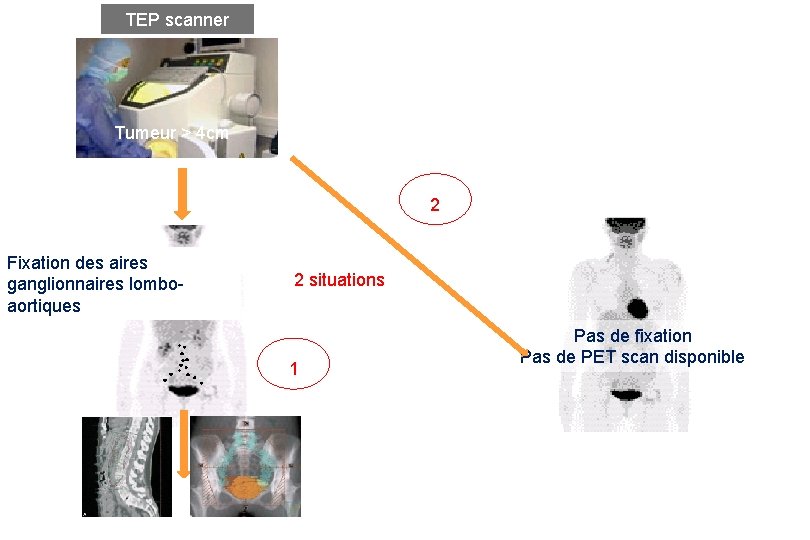 TEP scanner Tumeur > 4 cm 2 Fixation des aires ganglionnaires lomboaortiques 2 situations