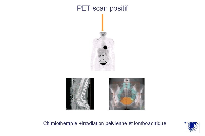 PET scan positif Tumeur > 4 cm Chimiothérapie +Irradiation pelvienne et lomboaortique 