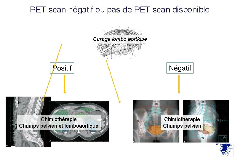 PET scan négatif ou pas de PET scan disponible Curage lombo aortique Positif Chimiothérapie