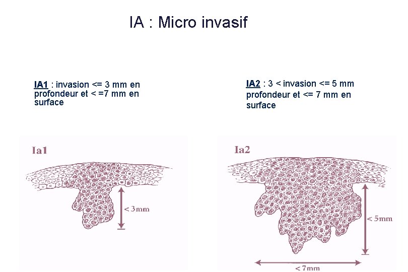 IA : Micro invasif IA 1 : invasion <= 3 mm en profondeur et