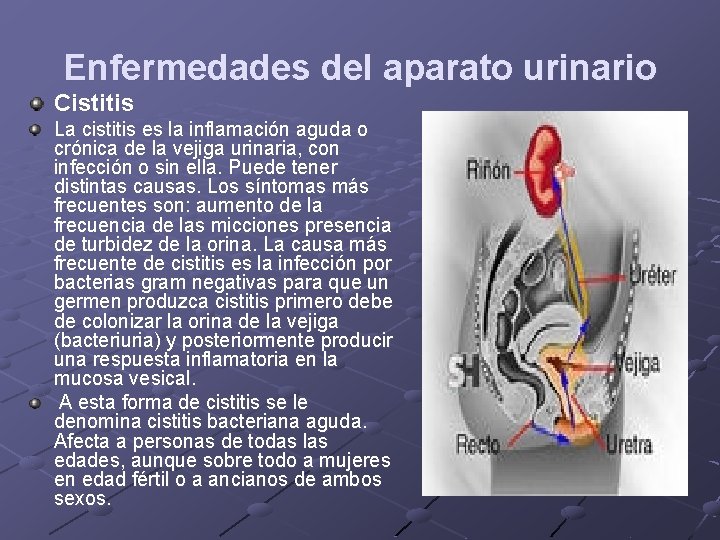 Enfermedades del aparato urinario Cistitis La cistitis es la inflamación aguda o crónica de