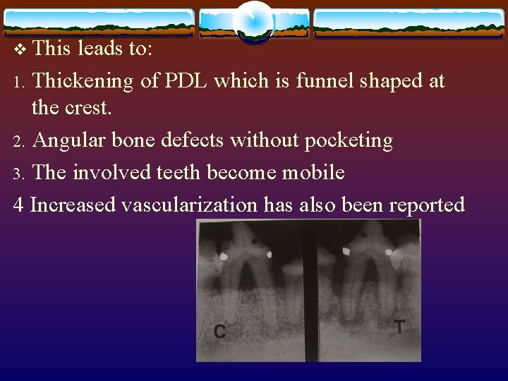 v This leads to: Thickening of PDL which is funnel shaped at the crest.