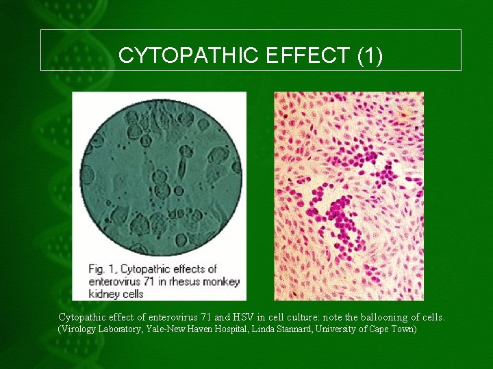 CYTOPATHIC EFFECT (1) Cytopathic effect of enterovirus 71 and HSV in cell culture: note