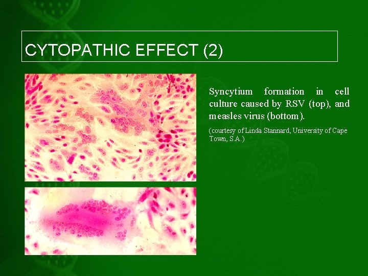 CYTOPATHIC EFFECT (2) Syncytium formation in cell culture caused by RSV (top), and measles