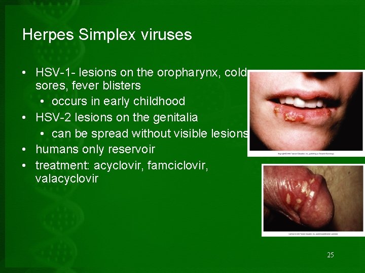 Herpes Simplex viruses • HSV-1 - lesions on the oropharynx, cold sores, fever blisters