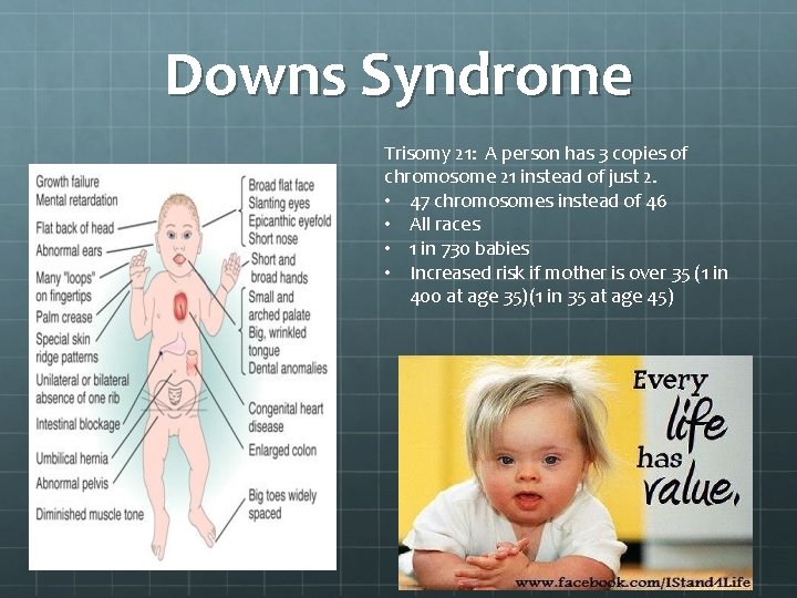 Downs Syndrome Trisomy 21: A person has 3 copies of chromosome 21 instead of