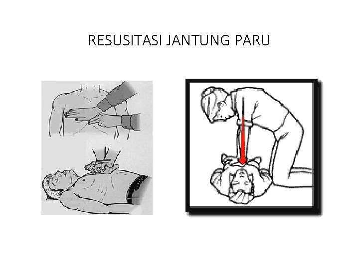 RESUSITASI JANTUNG PARU 