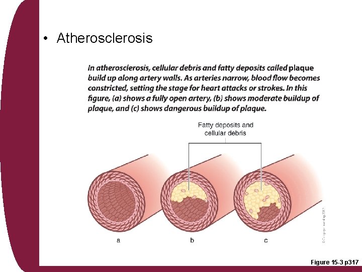  • Atherosclerosis Figure 15 -3 p 317 