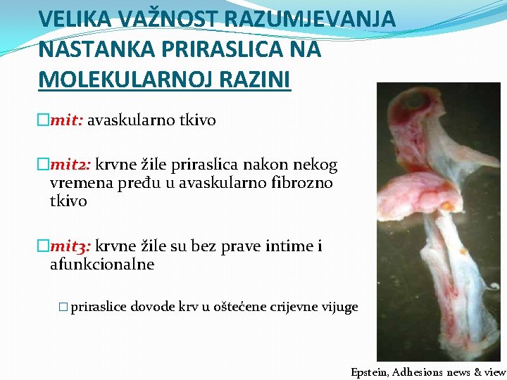 VELIKA VAŽNOST RAZUMJEVANJA NASTANKA PRIRASLICA NA MOLEKULARNOJ RAZINI �mit: avaskularno tkivo �mit 2: krvne VELIKA VAŽNOST RAZUMJEVANJA NASTANKA PRIRASLICA NA MOLEKULARNOJ RAZINI �mit: avaskularno tkivo �mit 2: krvne