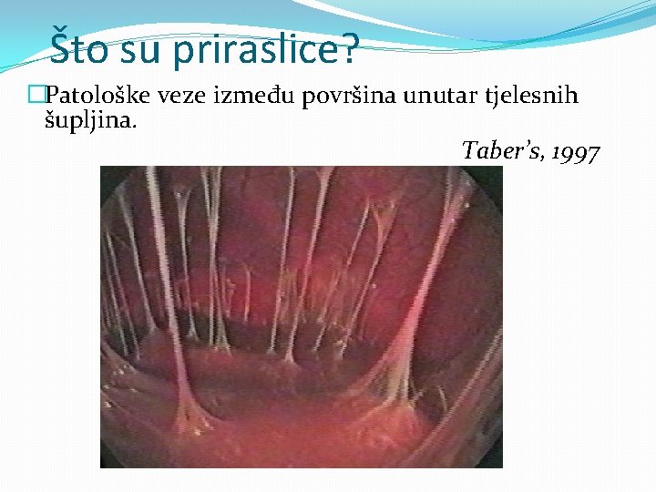 Što su priraslice? �Patološke veze između površina unutar tjelesnih šupljina. Taber’s, 1997 Što su priraslice? �Patološke veze između površina unutar tjelesnih šupljina. Taber’s, 1997