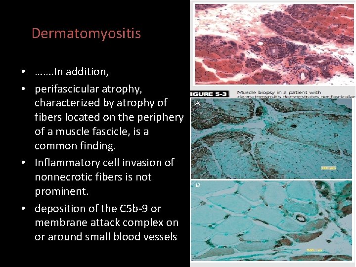 Dermatomyositis • ……. In addition, • perifascicular atrophy, characterized by atrophy of fibers located