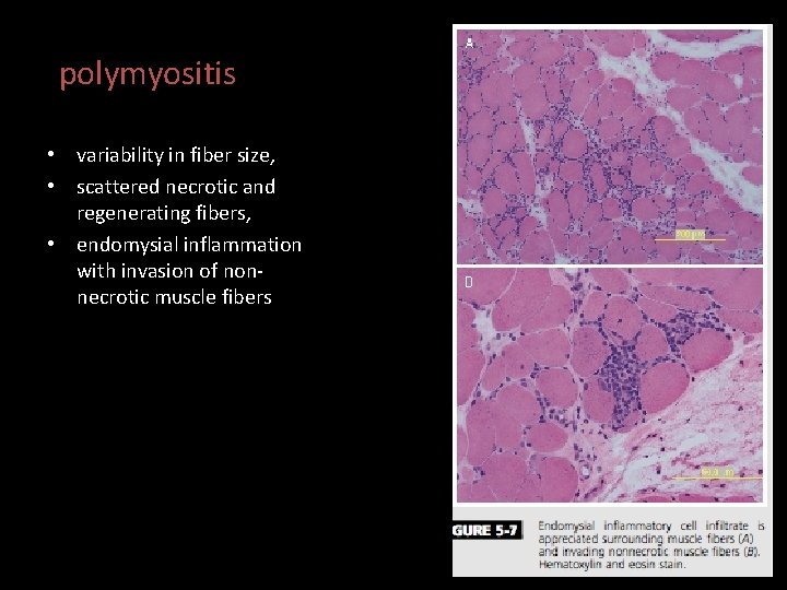 polymyositis • variability in fiber size, • scattered necrotic and regenerating fibers, • endomysial