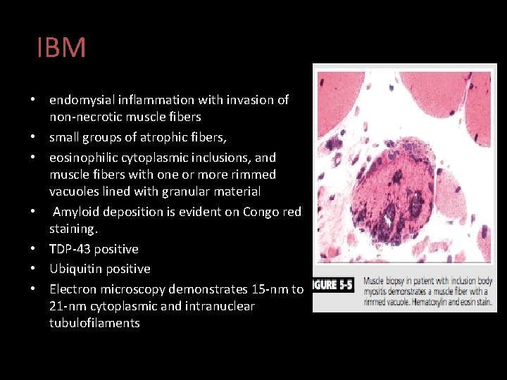 IBM • endomysial inflammation with invasion of non-necrotic muscle fibers • small groups of