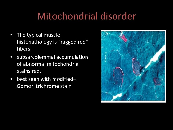 Mitochondrial disorder • The typical muscle histopathology is “ragged red’’ fibers • subsarcolemmal accumulation