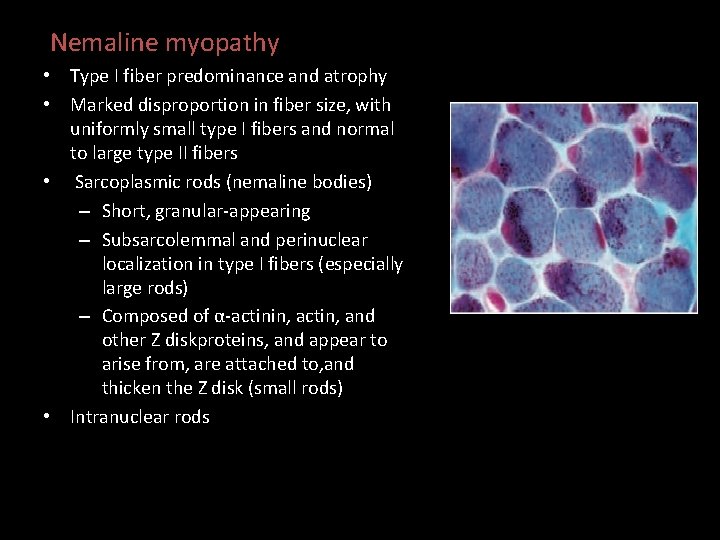 Nemaline myopathy • Type I fiber predominance and atrophy • Marked disproportion in fiber