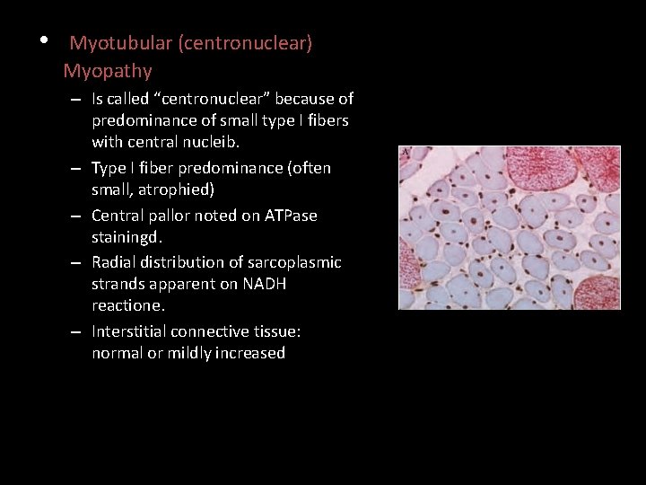  • Myotubular (centronuclear) Myopathy – Is called “centronuclear” because of predominance of small