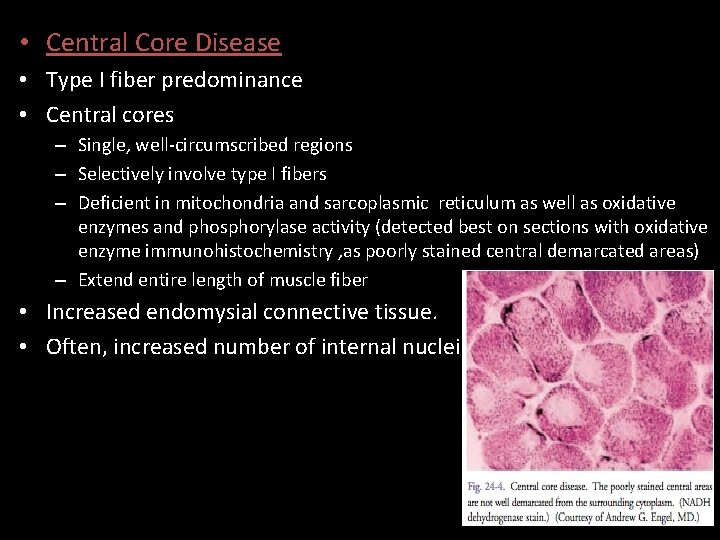  • Central Core Disease • Type I fiber predominance • Central cores –