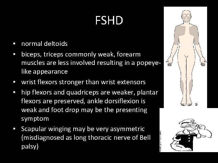 FSHD • normal deltoids • biceps, triceps commonly weak, forearm muscles are less involved