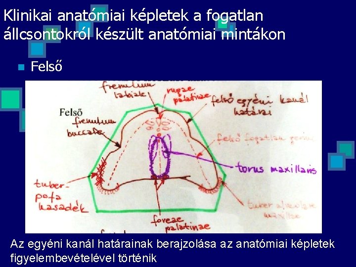 Klinikai anatómiai képletek a fogatlan állcsontokról készült anatómiai mintákon n Felső Az egyéni kanál