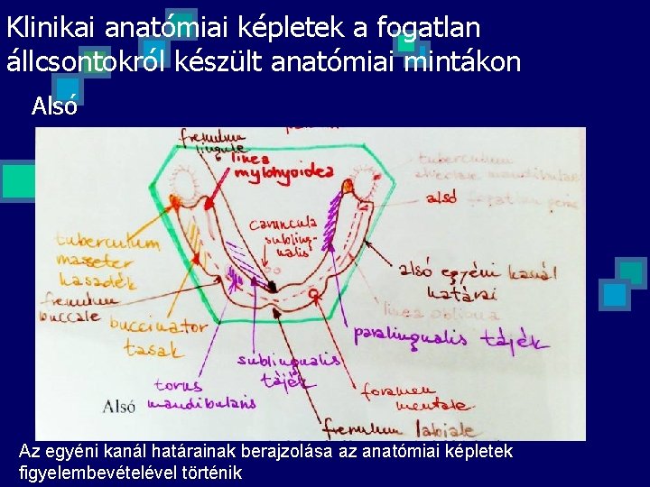 Klinikai anatómiai képletek a fogatlan állcsontokról készült anatómiai mintákon Alsó Az egyéni kanál határainak