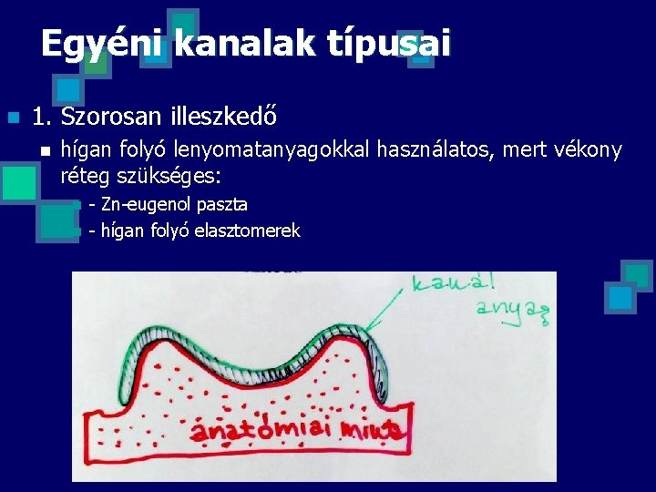 Egyéni kanalak típusai n 1. Szorosan illeszkedő n hígan folyó lenyomatanyagokkal használatos, mert vékony