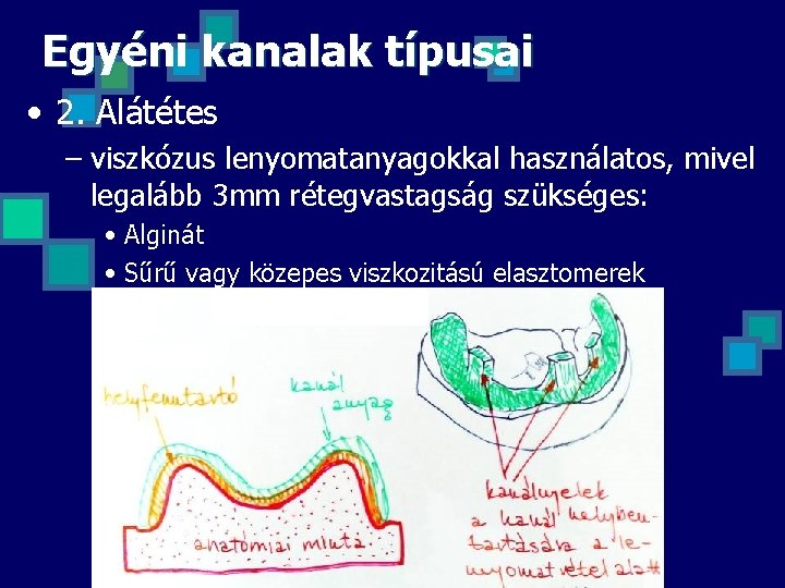 Egyéni kanalak típusai • 2. Alátétes – viszkózus lenyomatanyagokkal használatos, mivel legalább 3 mm