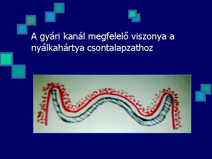 A gyári kanál megfelelő viszonya a nyálkahártya csontalapzathoz 