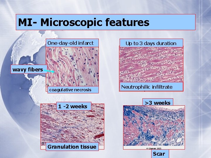 MI- Microscopic features One-day-old infarct Up to 3 days duration wavy fibers coagulative necrosis