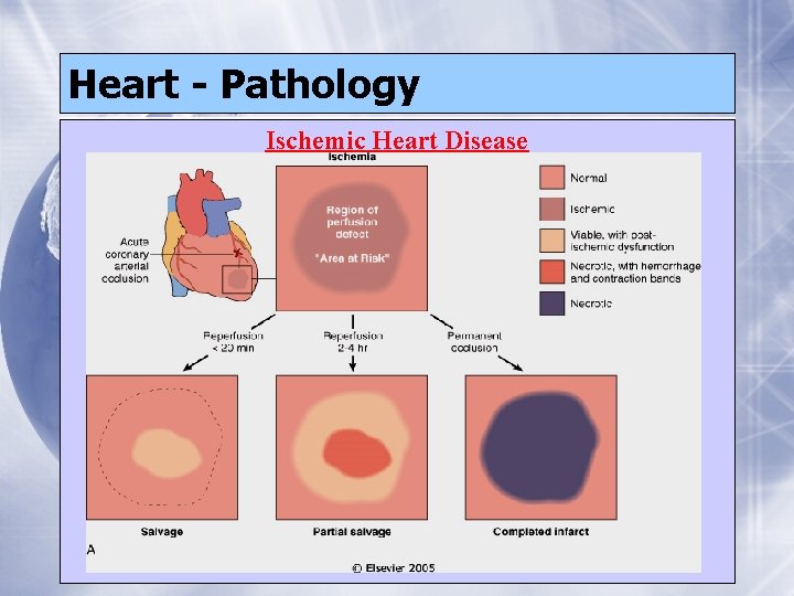 Heart - Pathology Ischemic Heart Disease 