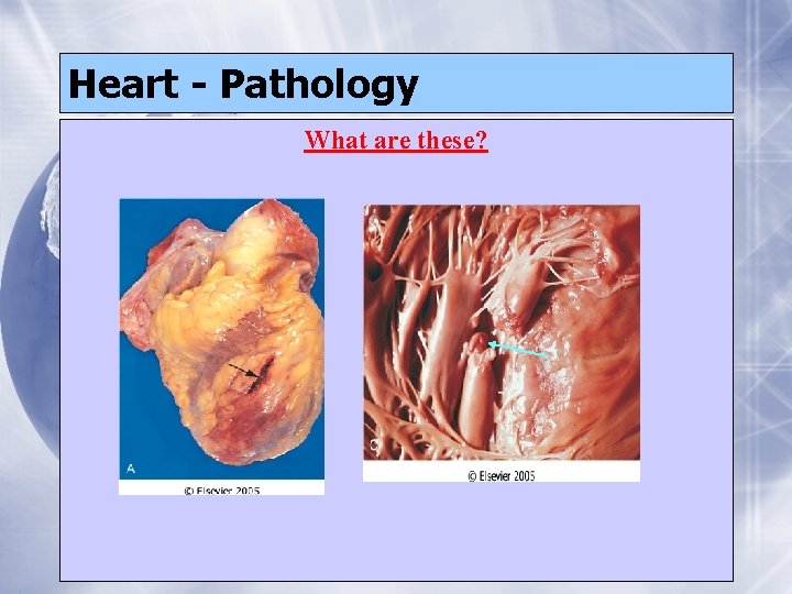Heart - Pathology What are these? 