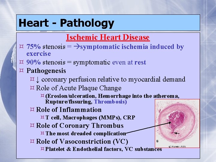 Heart - Pathology Ischemic Heart Disease 75% stenosis = symptomatic ischemia induced by exercise