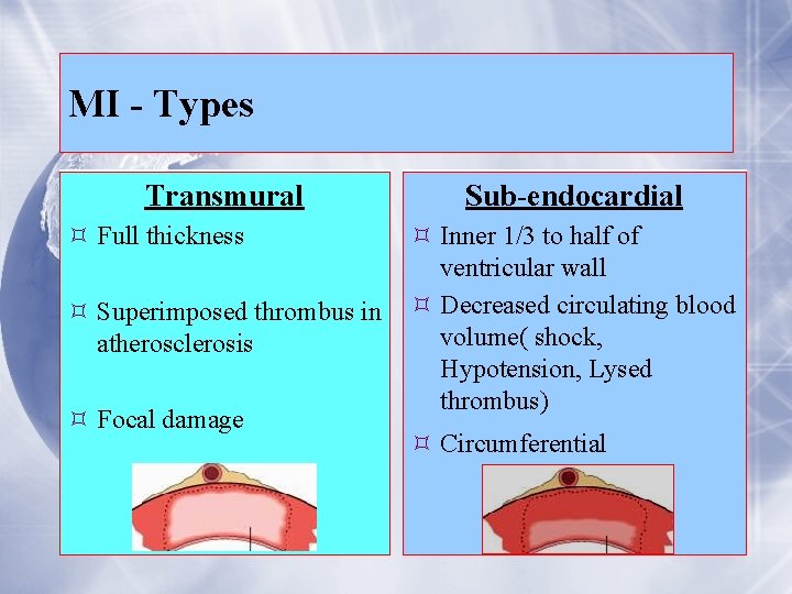 MI - Types Transmural Full thickness Superimposed thrombus in atherosclerosis Focal damage Sub-endocardial Inner