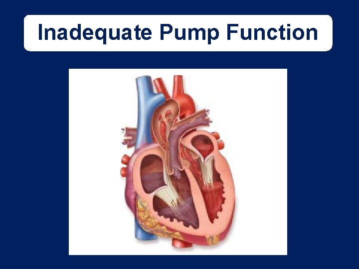 Inadequate Pump Function Fig. 15 -02 Don’t have art yet - WDS 